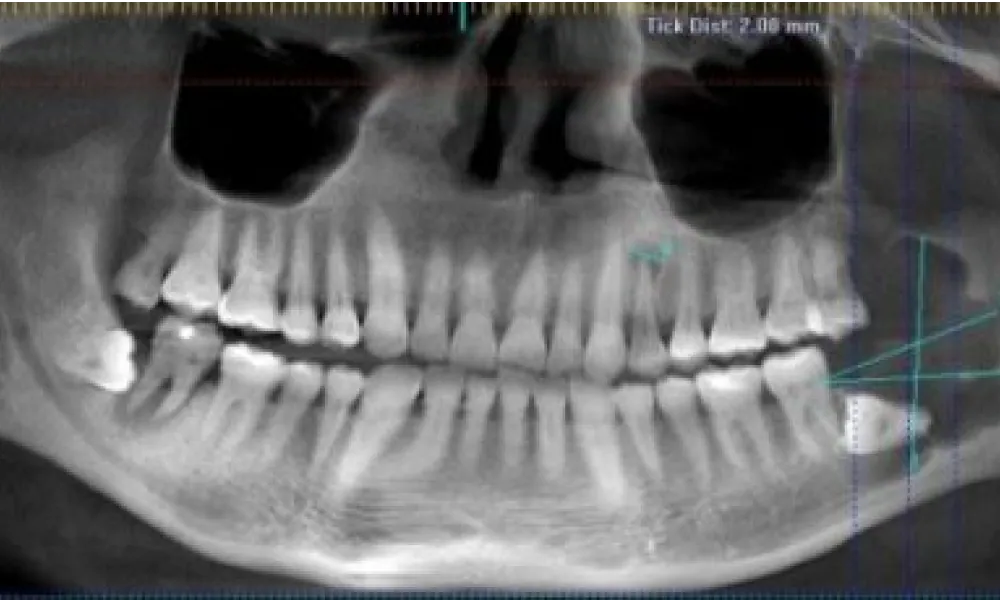 Clinical photo from Isidro's jaw tumor removal and reconstruction case